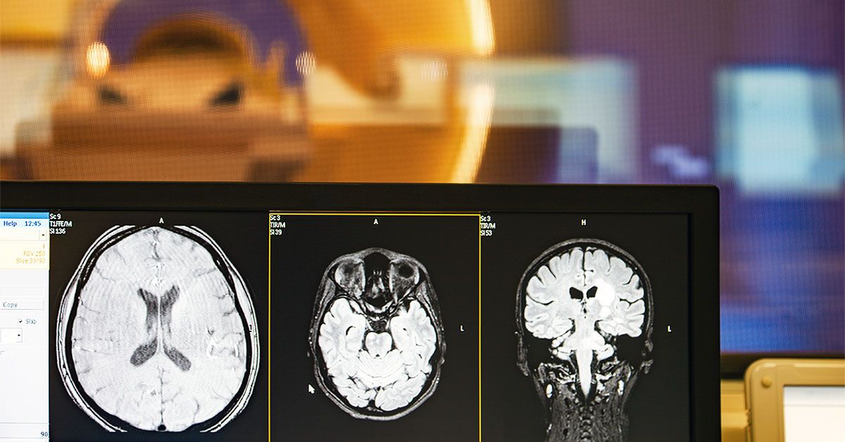 Gut microbiome may drive memory loss via vagus nerve