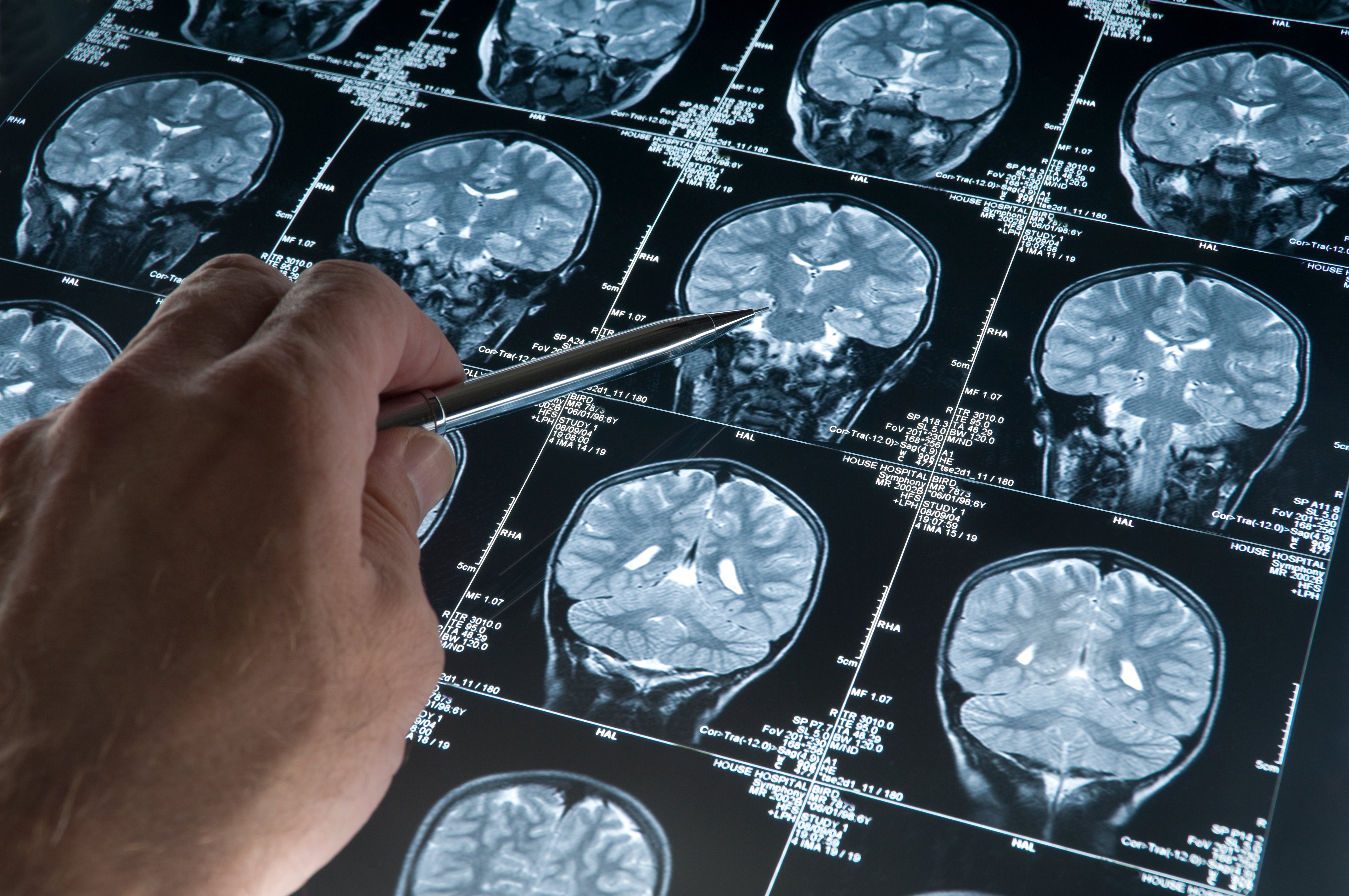 The study included participants having at least two brain MRI scans
