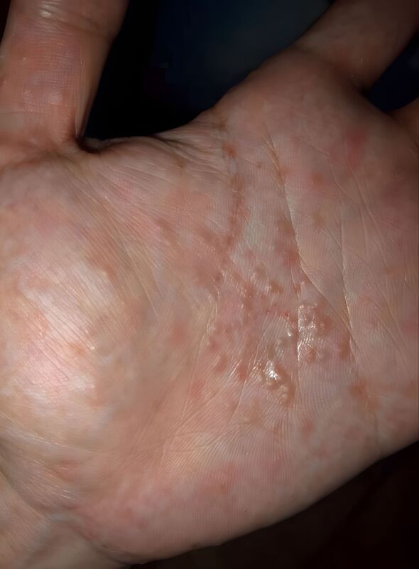 Scabies Infestation, A Hand with Pustules and Rashes on the Palm.