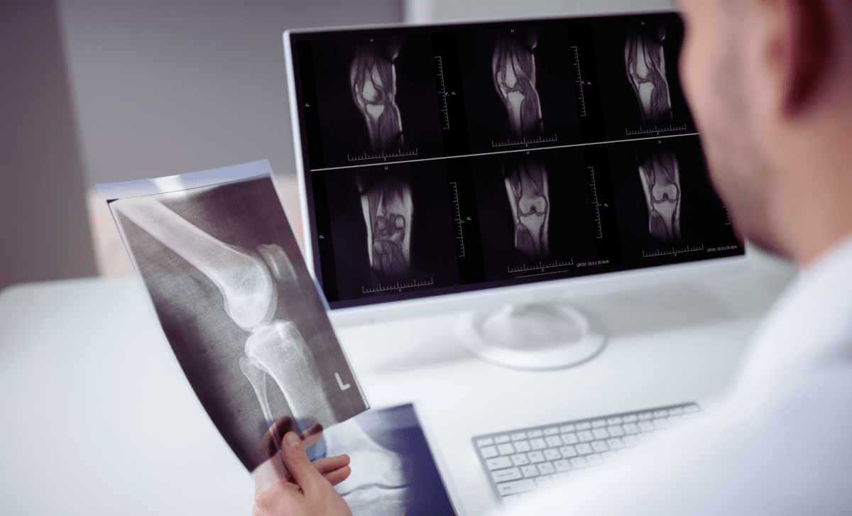 Scientists Discover Breakthrough That May Reverse Osteoporosis And Strengthen Bones
