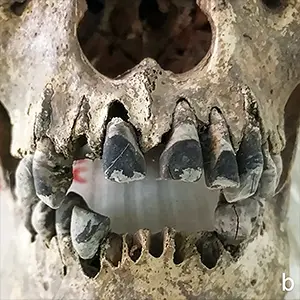Comparison of dental residue possibly resulting from different practices: (a) reddish-brown staining on teeth from Gua Harimau, Sumatra (courtesy Prof. Truman Simanjuntak; photograph by Hsiao-chun Hung); (b) a black pigment layer on teeth from Dong Xa, Vietnam. Credit: Archaeological and Anthropological Sciences