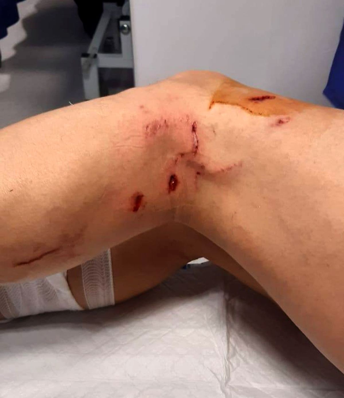 The deepest puncture wounds were on Leon's left leg behind his knee