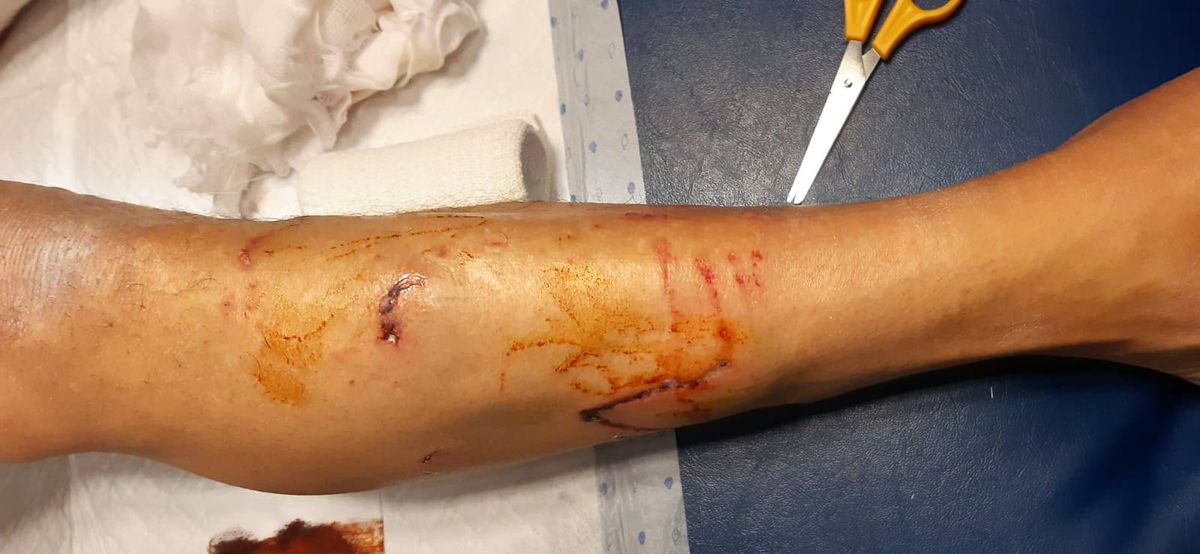 The wounds have begun healing but the incident has left mental scars