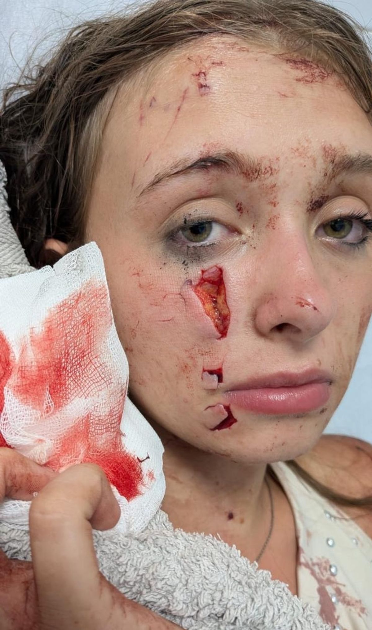 Madison Bagley's injuries after being attacked by Jessica Cloke at the Sovereign Base Area in Cyprus 