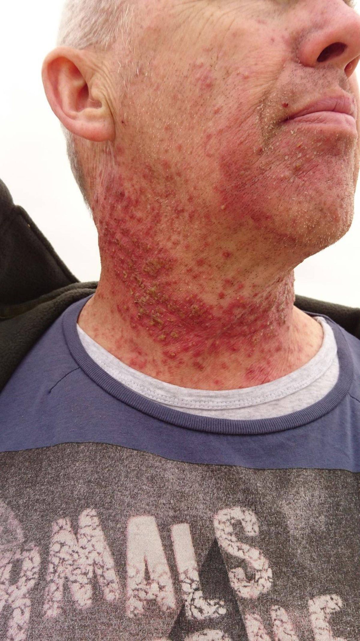 Alt text: An individual is depicted from behind, exhibiting a noticeable rash or inflammation around the neck area, extending onto the upper chest. The affected skin appears reddened and irritated, with a close-up focus highlighting the texture and distribution of the rash. The individual is dressed in a blue shirt, and the background is blurred, emphasizing the skin condition.