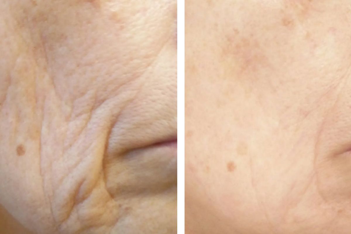 Before and after using Reverse Life's collage supplement with wrinkles on one side and less on the other