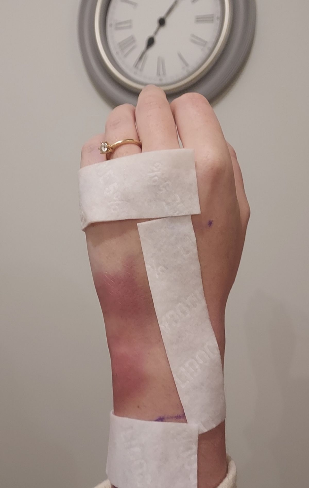 Sophie's injured hand