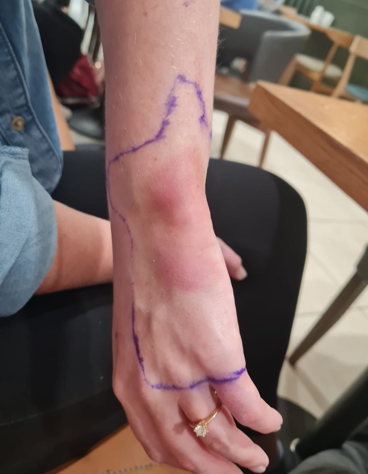 Even amputation may not help