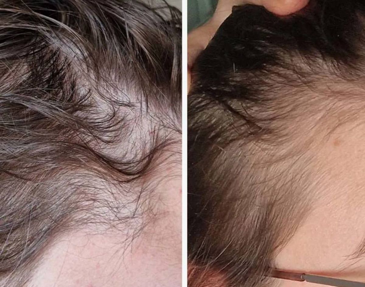 Before and after using Dr Vegan's Hair Saviour supplement