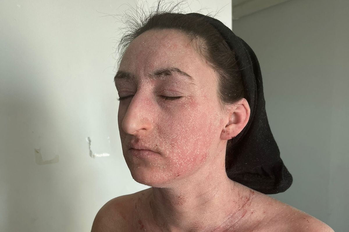 Rosemary showing her skin