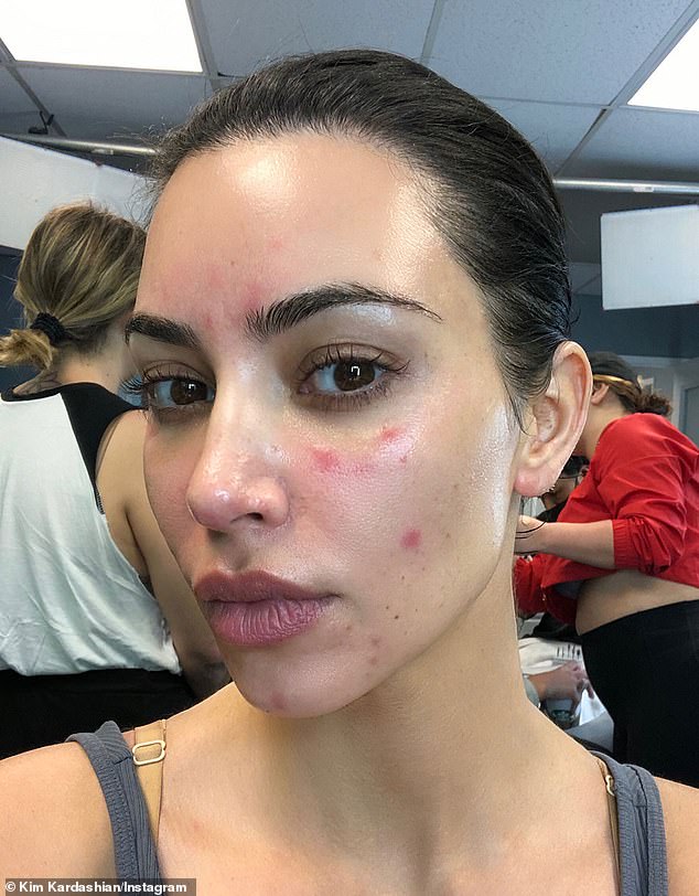 Reality television star Kim Kardashian revealed she had been diagnosed with psoriasis seven years ago