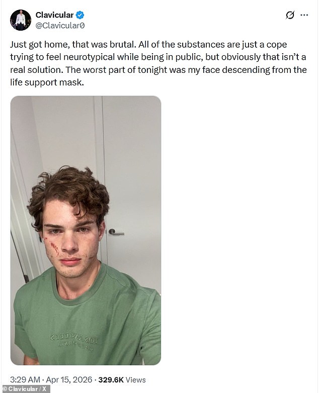 The 20-year-old 'looksmaxxer' - real name Braden Eric Peters - claimed on X Wednesday morning  that his situation was so serious that he was given a life support mask