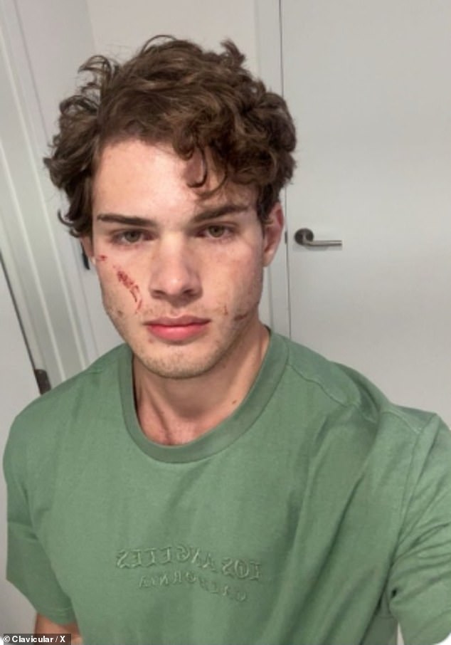Clavicular has revealed that he is home after being rushed to the hospital following a suspected overdose amid an unsettling livestream that suddenly ended on Tuesday night