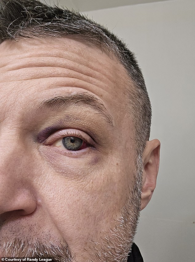 League is shown above shortly after bursting blood vessels in his left eye. Bruising and the beginnings of a black eye are clearly visible