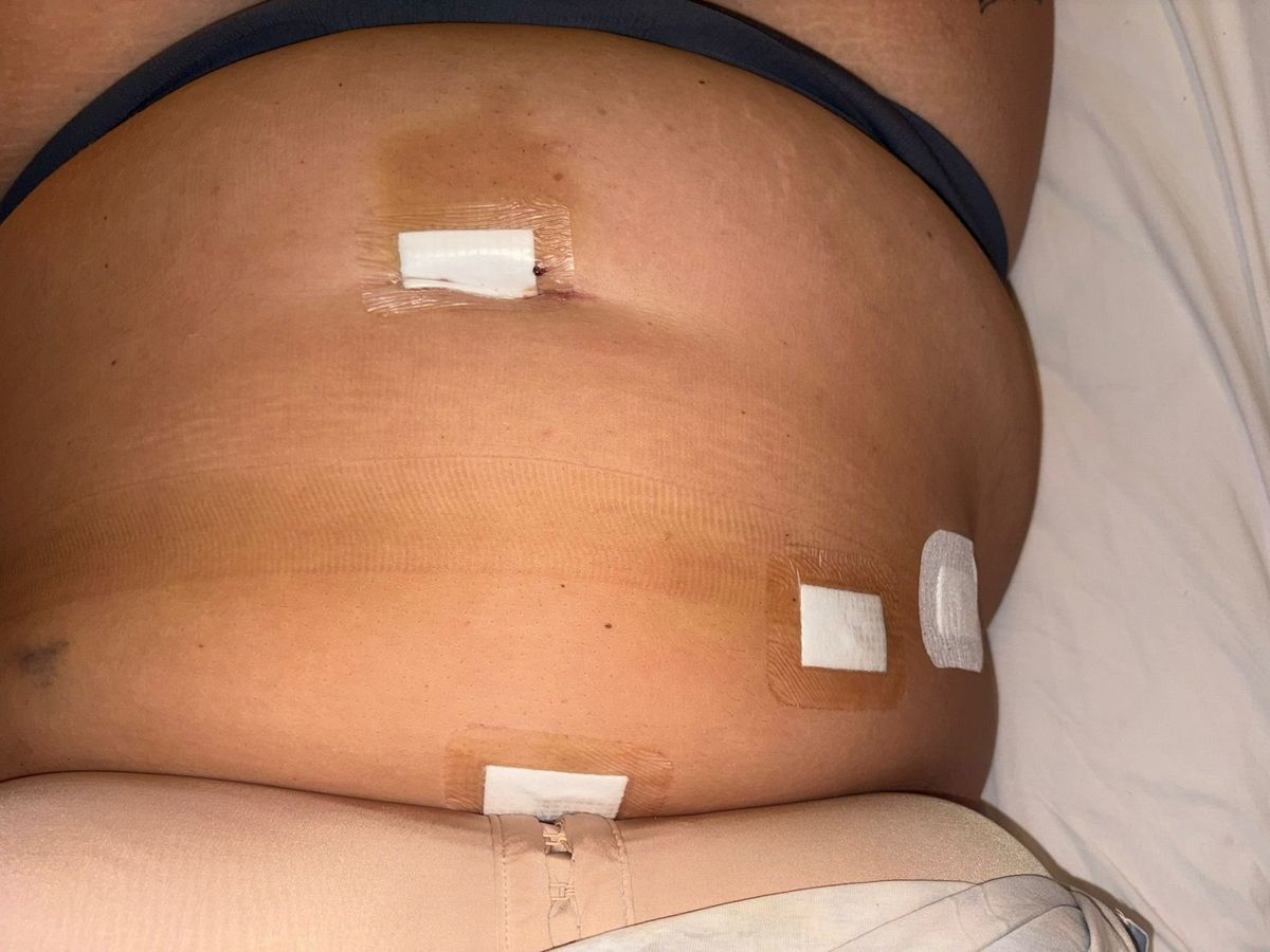 Sarah-Jayne Crawford's stomach after getting her gallbladder removed