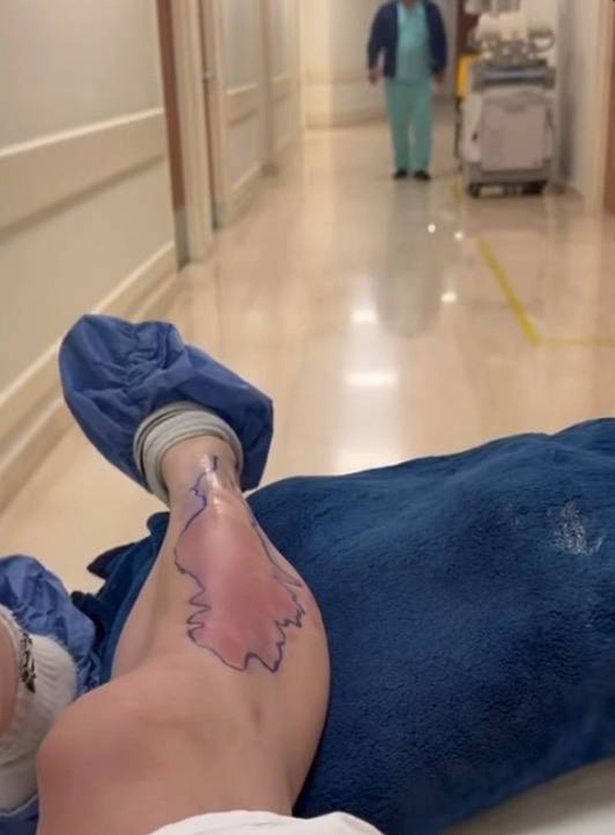 The singer showed the extent of the bite on her leg