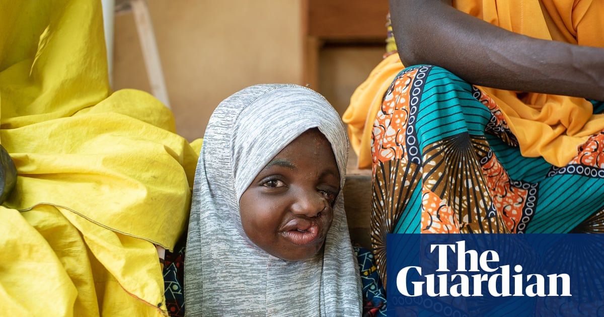 ‘Astonishing’ discovery could help save children from deadly disfiguring condition | Global development