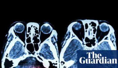 Key stroke treatment still not available around the clock across England | Stroke