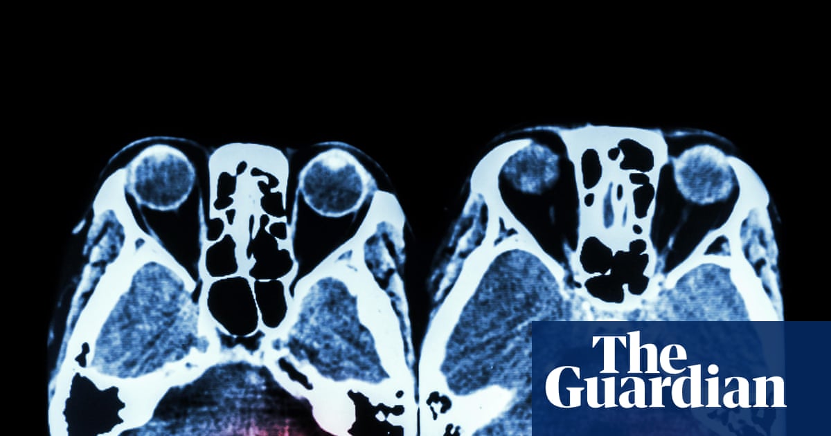 Key stroke treatment still not available around the clock across England | Stroke
