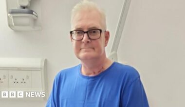 Darren White, 53, from Stockton-on-Tees, who is one of the first lung transplant patients in the UK to have a patch of their organ donors skin grafted onto their forearm in the hope that it could help medics spot signs of the lung being rejected by the body sooner.