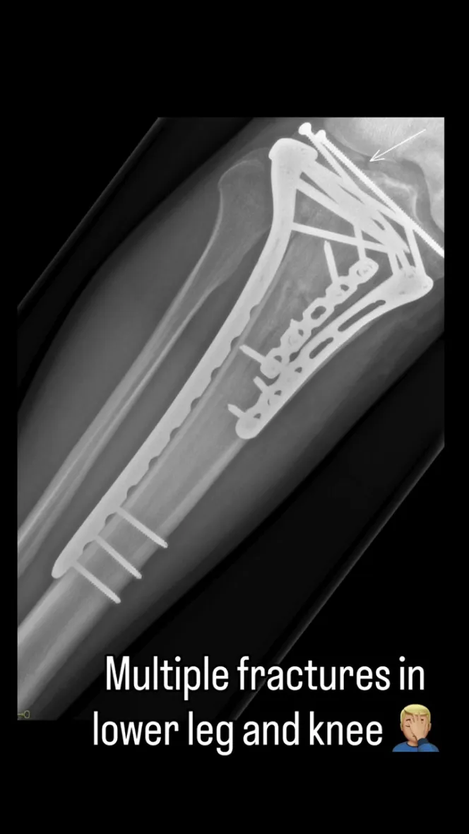 X-ray of Sir Chris Hoy's broken leg with multiple fractures.