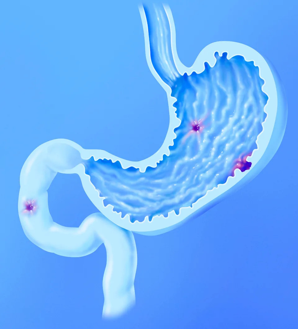 Cross-section of the stomach with gastric ulcers and a duodenal ulcer, seen in section with its gastric mucosa. At the top, the esophagus opens into the stomach.