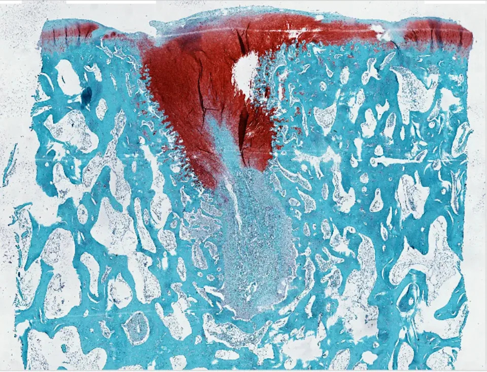 hyaluronic acid, cartilage repair, natural polymers, structure, surgery, regrow cartilage