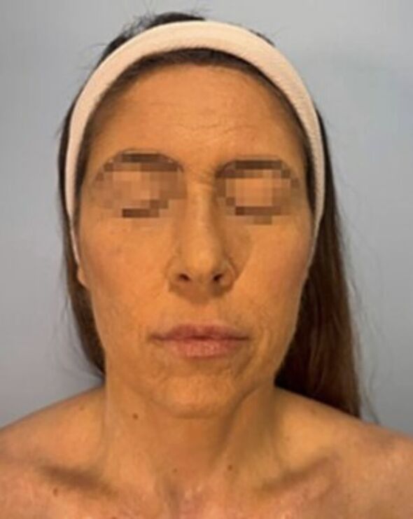 Woman’s FACE started burning off after rare reaction to depression medication Woman’s FACE started burning off after rare reaction to depression medication