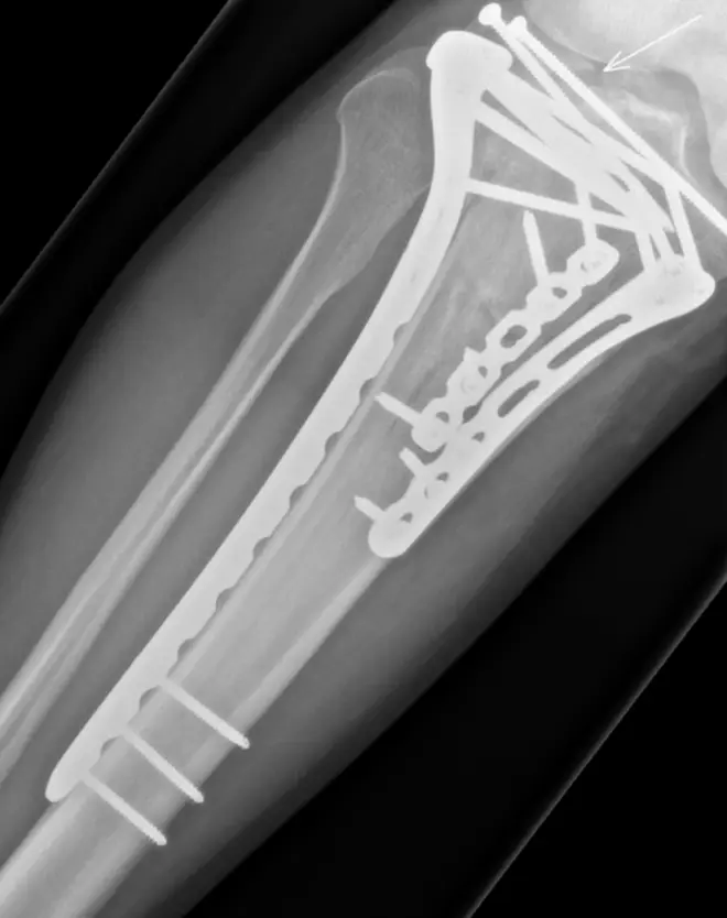 Sir Chris shared images of the multiple fractures in his lower leg and knee