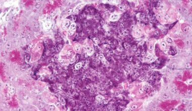 A close up of the pancreas, where purple and pink stained cells can be seen with dark dots for their nucleii