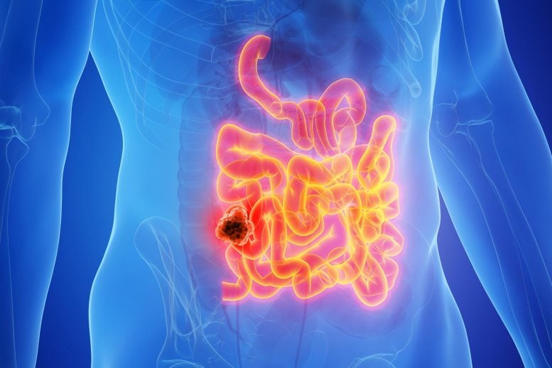 Male Anatomy Cancer Small Intestine