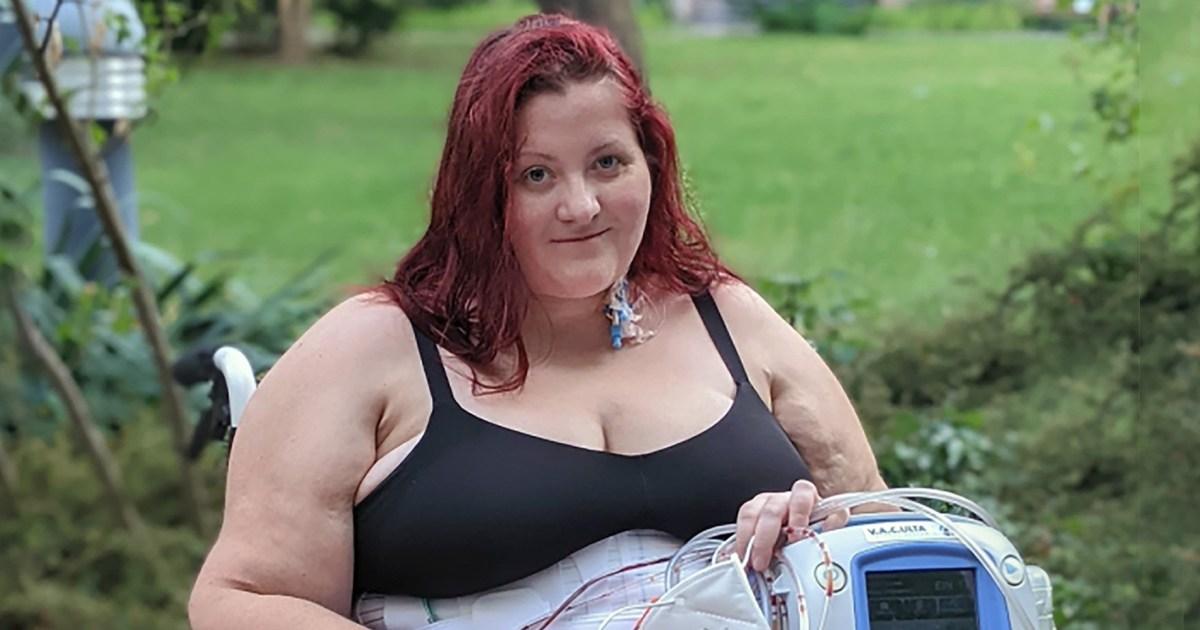 Shocking photo reveals giant 'unfixable' hernia in woman's stomach