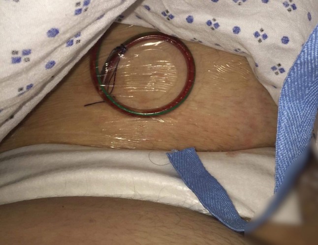 Pic from Kennedy News/@stevenHamillStories (Pictured:STEVEN HAMILL, AGED 26, IN HOSPITAL AFTER HAVING HIS PARTIAL PENECTOMY.)A bloke nicknamed 'Stumpy' by pals after having half his penis removed due to cancer managed to become a dad - even after having FOUR INCHES amputated. Steven Hamill, from Cheshire, feared the worst when he was originally diagnosed with penile cancer but after undergoing a partial penectomy he's now in remission. The 33-year-old said he was 'really lucky' that he was well-endowed before the op as he's still able to have sex - even becoming a dad in 2022. DISCLAIMER: While Kennedy News and Media uses its best endeavours to establish the copyright and authenticity of all pictures supplied, it accepts no liability for any damage, loss or legal action caused by the use of images supplied and the publication of images is solely at your discretion. SEE KENNEDY NEWS COPY - 0161 697 4266