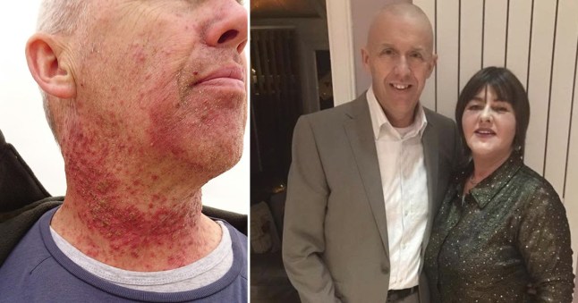 The burns on Jeff Bradford's neck after undergoing radiotherapy for stage three cancer.