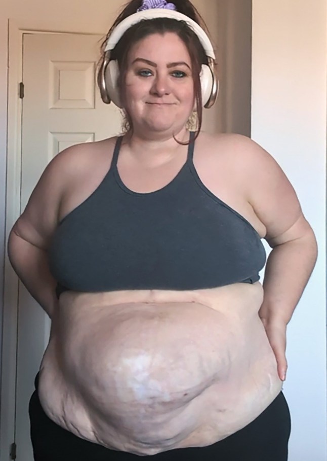hernia_troll_uk / CATERS NEWS - (PICTURED Amy before surgery) Check out this woman???s incredible story as she refuses to give up hope while living with a giant hernia that some said was too large to repair.Amy Bamford, 35, from Chesterfield, UK, has opened up about her daily struggle with a massive abdominal hernia that developed following several life-saving procedures.While her surgeries for abdominal issues and lipoedema in Germany ultimately saved her life, they left her with a complex medical condition that has grown significantly over the last few years.Lipoedema is a long-term condition where fat builds up abnormally, usually in the legs, thighs, hips and sometimes arms.SEE CATERS COPY