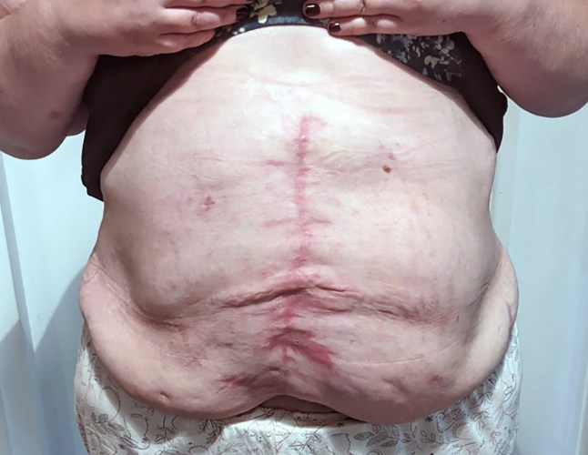 hernia_troll_uk / CATERS NEWS - (PICTURED Amy surgery scar) Check out this woman???s incredible story as she refuses to give up hope while living with a giant hernia that some said was too large to repair.Amy Bamford, 35, from Chesterfield, UK, has opened up about her daily struggle with a massive abdominal hernia that developed following several life-saving procedures.While her surgeries for abdominal issues and lipoedema in Germany ultimately saved her life, they left her with a complex medical condition that has grown significantly over the last few years.Lipoedema is a long-term condition where fat builds up abnormally, usually in the legs, thighs, hips and sometimes arms.SEE CATERS COPY