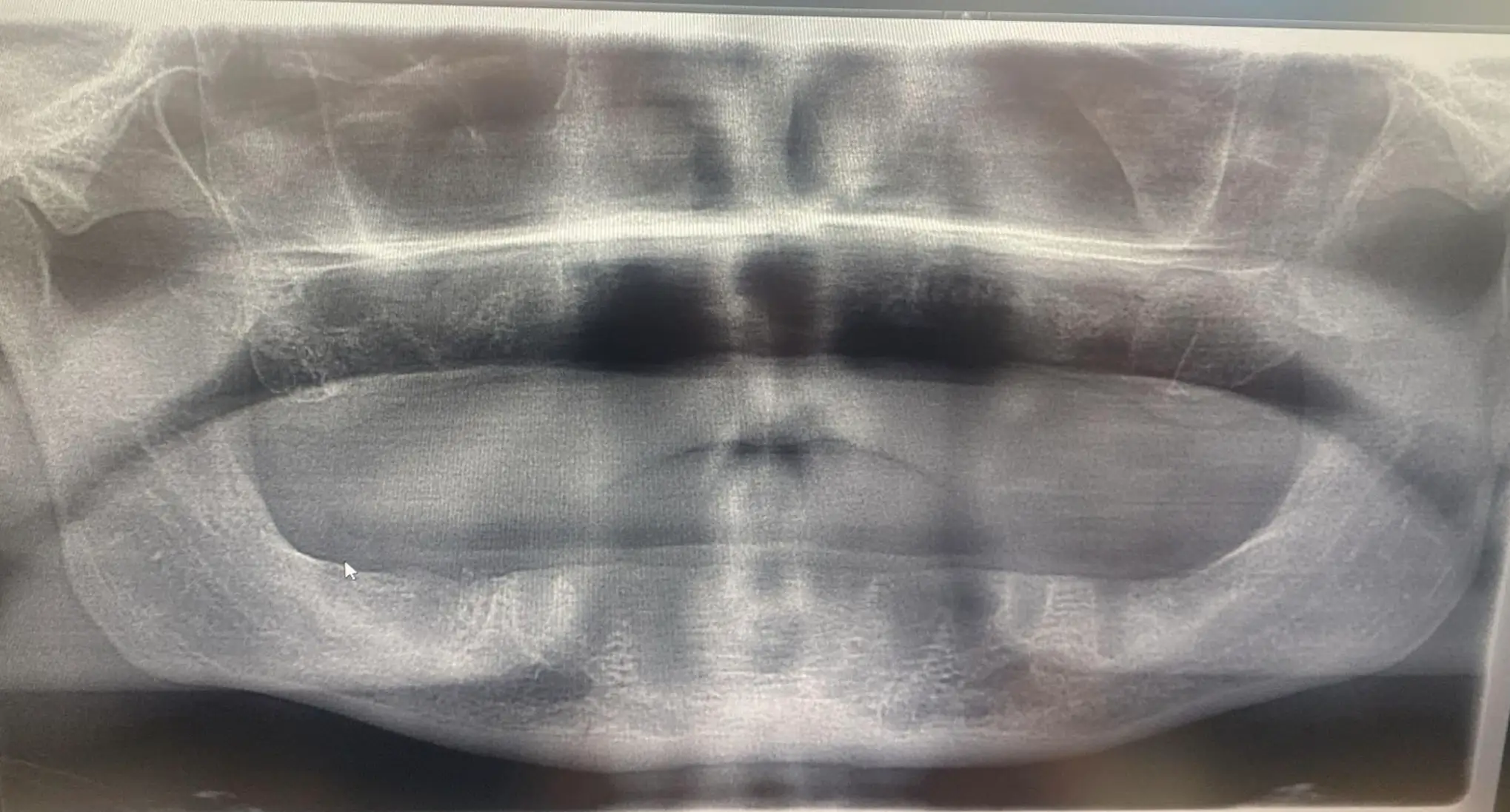 Jon said he was left 'devastated' when he woke up to find the dentist had removed all of his implants (Kennedy News and Media)