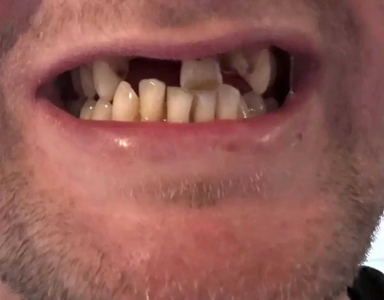 The dad's teeth started to deteriorate after his bike accident in 2020, prompting him to head to Turkey to have some dental work done (Kennedy News and Media)