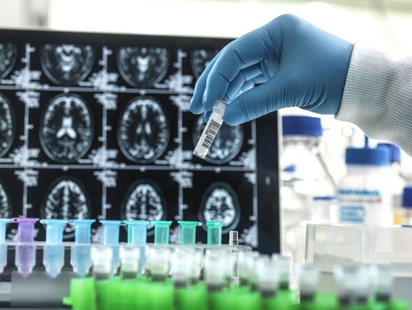 Alzheimers and dementia research Alzheimers and dementia research