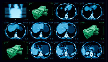 AI could check millions of lung cancer scans for heart risk. Who will pay for it?