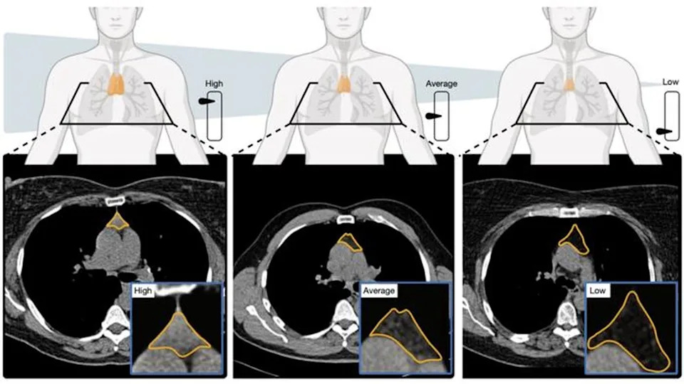 AI model analyses CT scans to estimate thymic health. Image depicts a comparison between high, average, and low thymic health and corresponding CT images (Mass General Brigham/Nature)