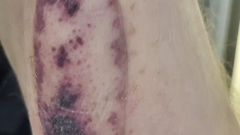 The skin patch grafted on to Mr White's forearm. Pic: PA