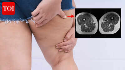 <p>Representative axial T1-weighted spin-echo thigh MRI scans in (A) a 61-year-old female participant and (B) a 62-year-old female participant. Both participants were of similar age and body mass index (BMI, calculated as weight in kilograms divided by height in meters squared). Both had Physical Activity Scale for the Elderly scores above the mean score in the study. According to the World Health Organization definition, the participant in B qualified as having abdominal obesity (abdominal circumference ≥ 88 cm). Abdominal circumference is a measure of central obesity that captures fat distribution and serves as an indicator of cardiometabolic health. Compared with the participant in A, the participant in B had a higher proportion of ultra-processed food (UPF) in their diet (87.1% vs 29.5%) and exhibited fattier thigh muscles bilaterally, with Goutallier grade (GG) for all thigh muscles summing to 25 for the participant in A and 38 for the participant in B.</p><p><br><strong>Credit<br>Radiological Society of North America (RSNA)</strong><br></p> Your junk food is turning your thighs into well-marbled steaks