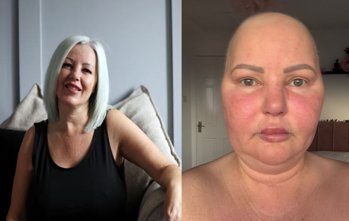 Emma Durkin following her diagnosis in 2022 (left) and as she is now (right)