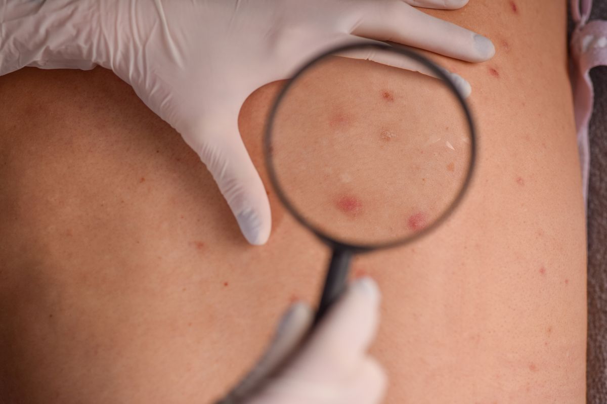 Dermatologist checking female infected skin with magnifier glass