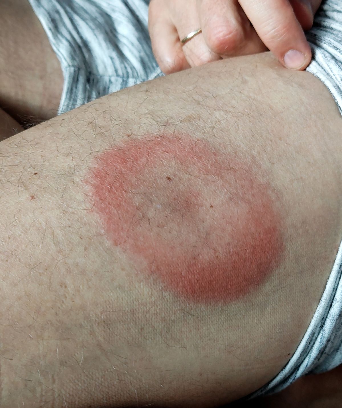 Tick bite