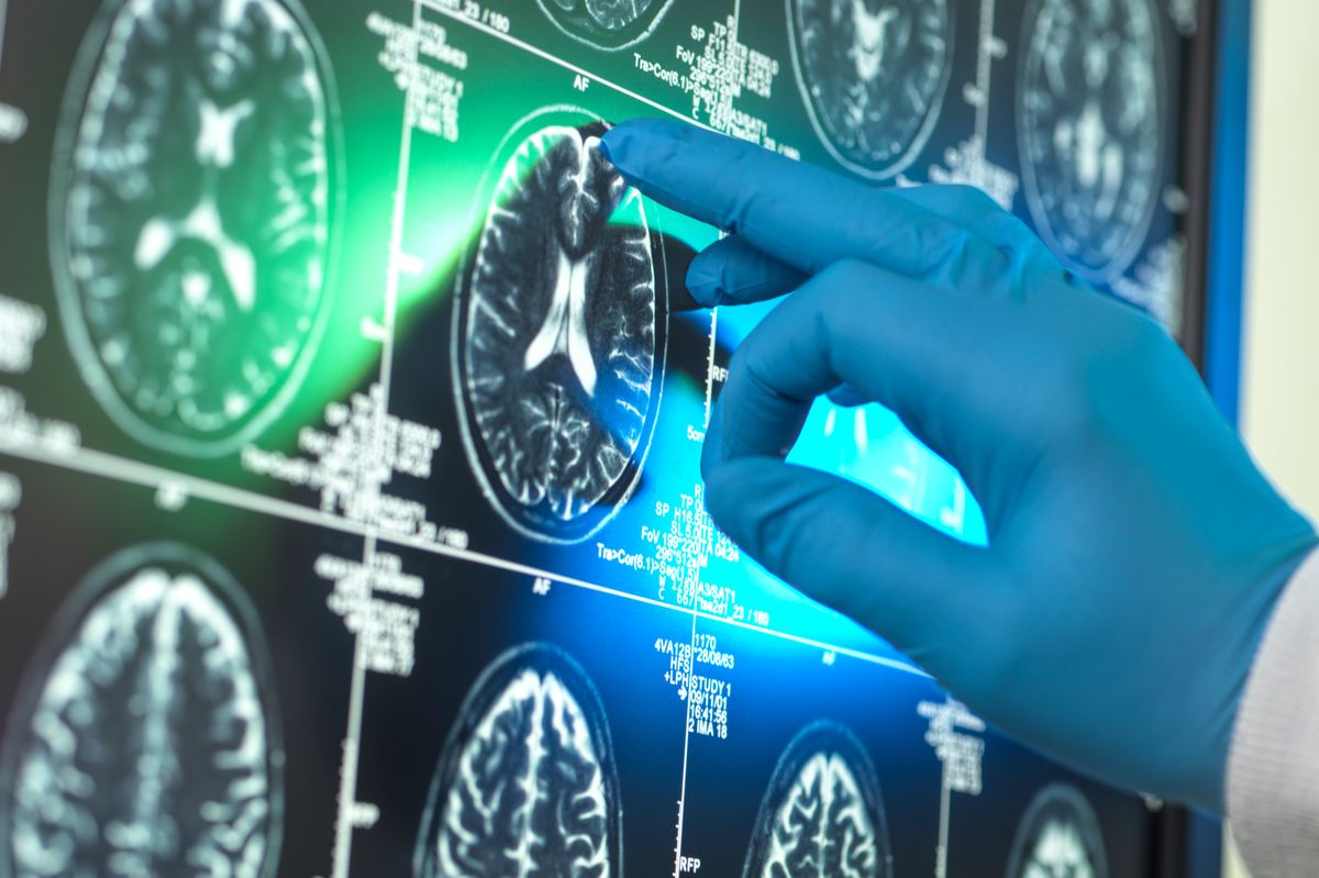 A doctor examines scans of a patient's brain