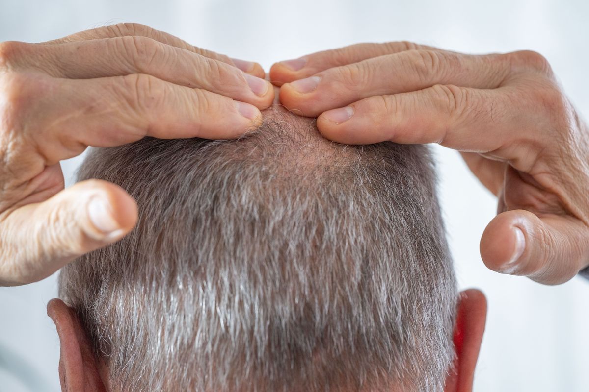 The drug is prescribed for hair loss