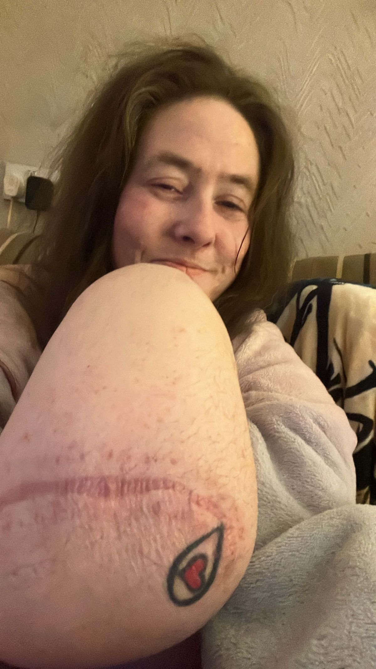 Jayme Stephen lost her leg