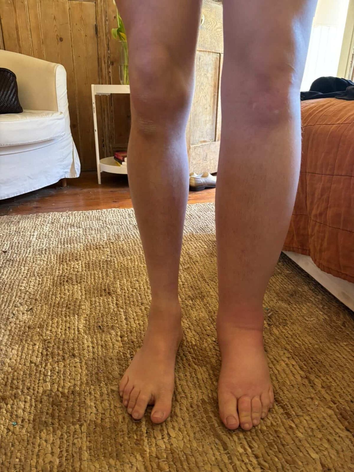 Sam's swollen leg compared to his normal one